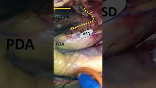 Infarct Exclusion Technique for Posterior Ischemic VSD in a Patient With Impella 5.5 Support