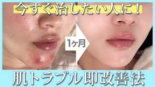 【肌質改善】たった1ヶ月で何年も悩んでいたニキビとおさらば！韓国美容のプロが超おすすめする美肌アイテム紹介✨