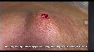 Blackhead removal,083, whitehead,pimple,acne,#blackheads , #acne ,#pimple ,#acnetreatment ,#asmr,#