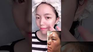 #exfoliate #skincare #acne #helpskin #acnetreatment #acneskin #cleanser #fyp #tiktokmademebuyit