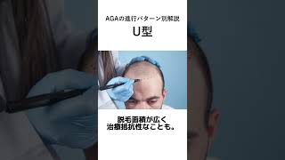 #aga治療 #ハゲ #薄毛治療
