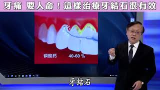 【牙痛 要人命！這樣治療牙結石很有效】【大愛醫生館精選】