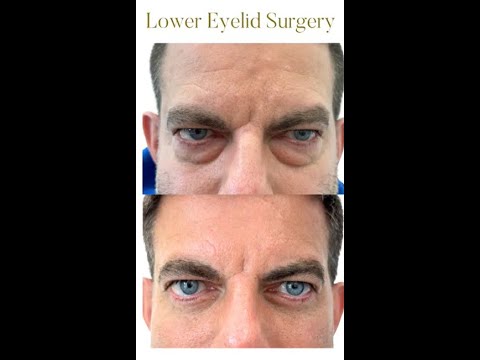 Lower Eyelid Surgery Patient Testimonial and Journey