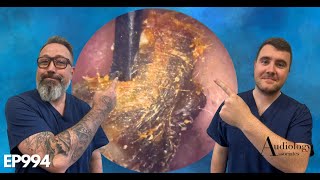 WE USED A MANUAL TOOL TO REMOVE EARWAX - EP994