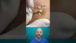 Do these whiteheads look like popcorn? 🍿 (@pimpleglow on TT) #satisfying #pimpleremoval #whiteheads