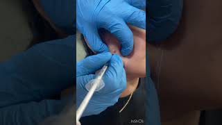Jawline slimmming by Masseter botox #botox #botoxinguwahati #orthoderm #botoxinjections