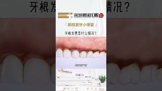 牙根發黑是什麽情況？這種情況可不能大意！  #深圳牙科  #鵬程口腔