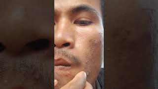 #skincare #pimplelife #songlyrics #skincareroutine #pimplecare #music #115 #vlog #antipimple #song