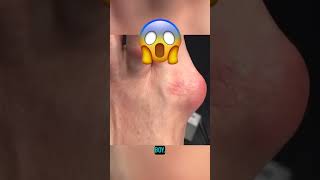 The best way to remove a bunion! 😱 #bunion #buniontreatment