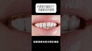 什麼是牙齒貼片？牙齒美白的過程#科普 #漲知識