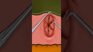 Instant navel stone removal 2022 #shorts #viral #shortvideo Damage Master