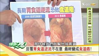反覆胃食道逆流不在意，最終變成食道癌！健康2.0