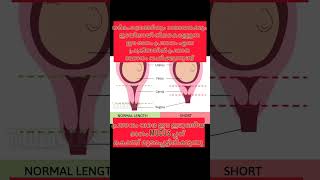 short cervix and pregnancy relation #baby #malayalam #pregnancy