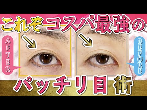 【👁‍🗨目、小さくなってない？】まぶたが下がりを「糸リフト＆ヒアルロン酸注入」で上げました【施術風景アリ】ワンデーリフトアップ・目元スッキリセット 湘南美容クリニック