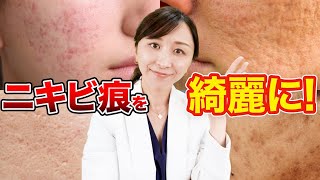 【完全版】ニキビ痕、これを見れば本当に効果のある改善方法がわかる！