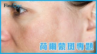 色斑種類多，可如何減淡荷爾蒙斑？－林嘉雯皮膚及性病科專科醫生@FindDoc.com