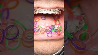 Dentist Reveals The BEST and WORST Elastic Colours For Your Teeth! 😭🦷