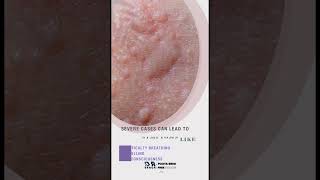 #skincare #drerror #hairdyn #skincare #drpooya #misdiagnosis #mari #allergic #cosmeticsurgery