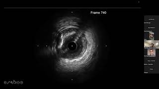 DCB Academy | Case-Based: How to Effectively Prepare Calcified Lesions