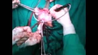 NDVH FOR MULTIPLE FIBROID (16 TO 18 WEEK SIZE)