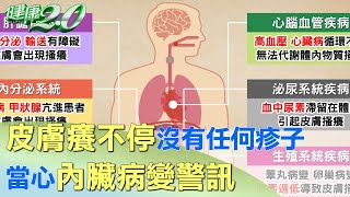 皮膚癢不停沒有任何疹子 當心內臟病變警訊 健康2.0