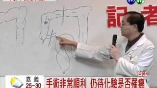 大腸有腫瘤 李前總統手術切除
