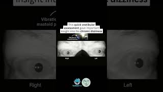 Vibration induced nystagmus test showing right unilateral vestibular loss #vestibularrehabilitation