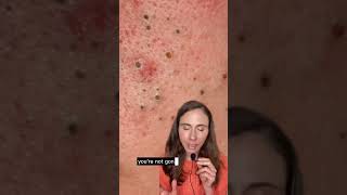 How to remove blackheads #dermatologist #blackheads #blackheadremoval