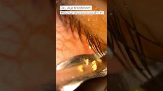 Meibomian gland expression after IPL