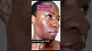 My Acne Journey. Don’t give up, stay CONSISTENT! #shorts #acneawareness