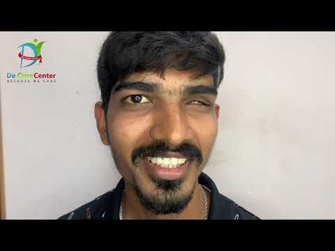 From ready made to Customise: A Patient's Journey with Ocular Prosthesis