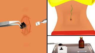 ASMR Huge Navel Stone Removal Animation | 거대한 배꼽 돌 제거 애니메이션
