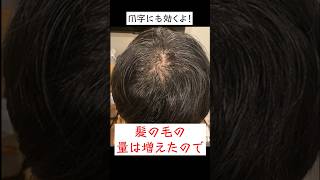 デュタステリドの薄毛治療効果がヤバすぎた #shorts
