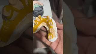 Cad cam 3d printed  partial framework in Mithila dental lab Ludhiana 😻😁😁😁#dental  #3dprinting