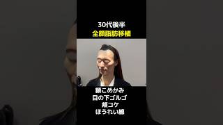 ダイエットが原因のコケ。究極の若返り。#美容 #脂肪注入 #脂肪注入ダウンタイム #頬コケ #ダイエット #額こめかみ #shorts