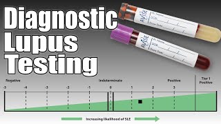 The Role of AVISE CTD in Lupus Diagnosis
