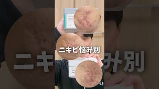 VT新作のシートマスクが出た！！【ニキビ肌必見】#PR