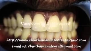 Best Dental Clinic in Chennai | Smile Makeover in Chennai