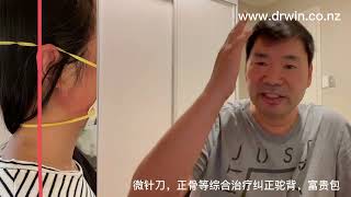 微针刀，正骨等综合治疗驼背，富贵包