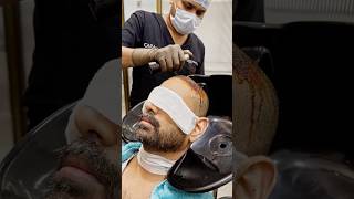 First Head Wash After Hair Transplant (Results) | Cara Clinic