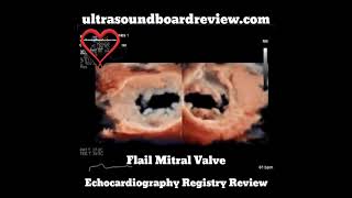 Flail Mitral Valve on 3D Echocardiography