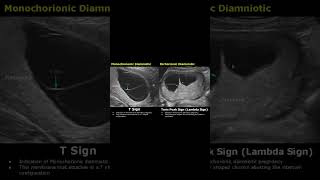 T-Sign & Twin Peak Sign (Lambda Sign) Fetal Ultrasound Scan | Pregnancy USG #shorts