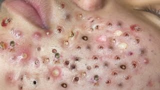 Loan Nguyen Acne Treatment 92c