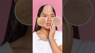 How to Treat Acne Scars & Open Pores #skincare #pores #scars