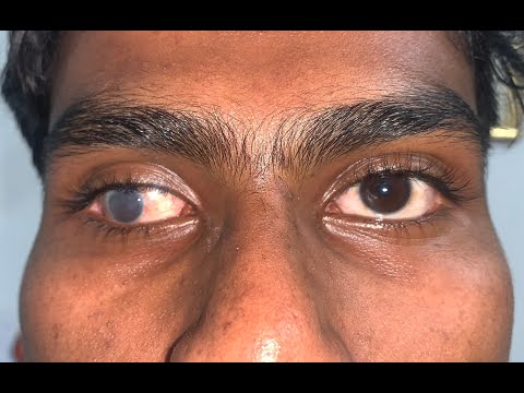 Lost eye treatment| Patient Regaining Confidence with a Custom Prosthetic Eye! 👁️✨
