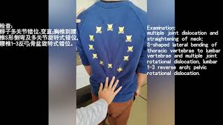 爱剪辑 运动损伤腰痛