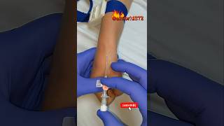 IV cannulation #aiworld@ivcannulation #ivcannulation #ivinsertion #hospital #foryou