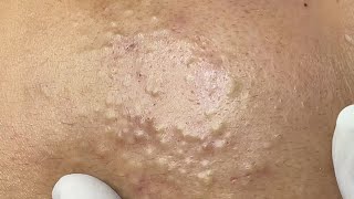 "Relaxing Deep Facial Cleaning | Gentle Skincare Session #520 P1