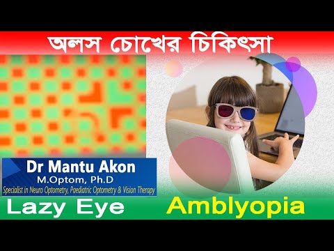 অলস চোখের চিকিৎসা। Amblyopia চিকিৎসা।Lazy Eye Treatment ।आलसी नेत्र उपचार।Dr Mantu Akon।