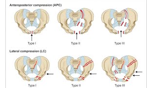 Pelvic fracture for NEET -SS/INI-SS